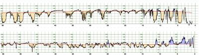 DeepCTG® 1.0: an interpretable model to detect fetal hypoxia from cardiotocography data during labor and delivery